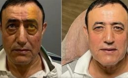 Mahmut Tuncer de estetik operasyon geçirdi